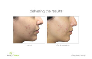 Venus Versa Acne Treatment