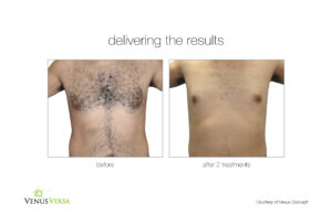 Venus Versa Hair Removal