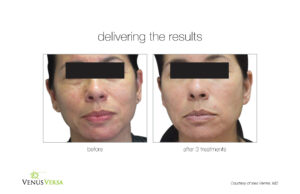 Venus Versa Skin Resurfacing