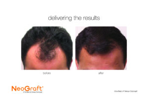 Neograft before and after results