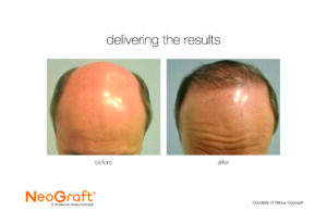 NeoGraft Results Before and After